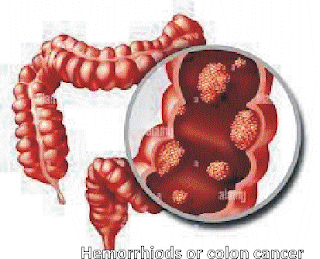 How To Use HEMORRHOIDS OR COLON CANCER CAN BE UNDERSTOOD BY SYMPTOMS To Desire Hemorrhoids symptoms , Colon cancer symptoms , Hemorrhoids vs colon cancer , Understanding hemorrhoids , Signs of hemorrhoids , Early symptoms of colon cancer , Hemorrhoids diagnosis , Colon cancer diagnosis , Hemorrhoids or cancer , Colon cancer warning signs , Rectal bleeding causes , Blood in stool symptoms , Painful bowel movements , Persistent abdominal pain , Swelling near anus , Hemorrhoids itching symptoms , Colon cancer fatigue , Unexplained weight loss signs , Changes in stool appearance , Chronic constipation